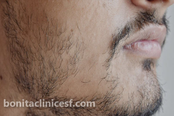 کاندیدای نامناسب کاشت ریش چه کسانی هستند؟