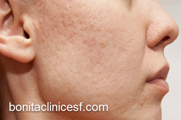 درمان اسکارهای پوستی در اصفهان | کلینیک بنیتا اصفهان