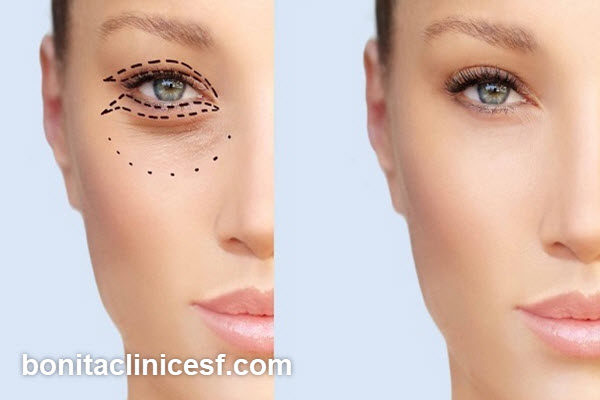 آشنایی با مراقبت های بعد عمل پلک افتاده | کلینیک بنیتا اصفهان