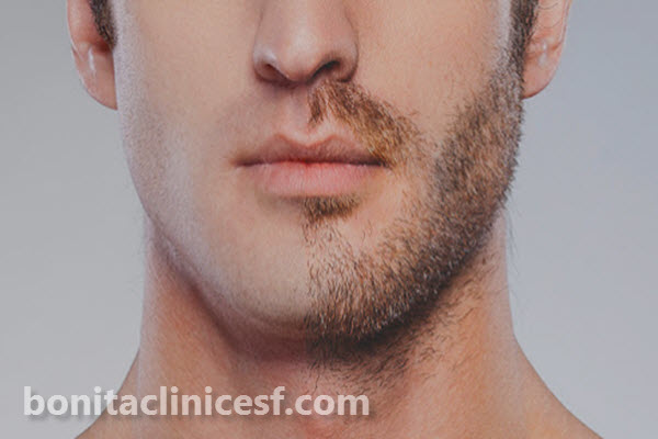 قیمت کاشت ریش و سبیل در اصفهان