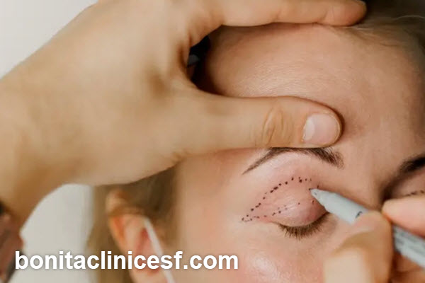 حداقل سن بلفاروپلاستی چقدر است؟ | کلینیک بنیتا اصفهان