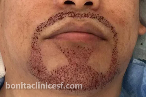 مراقبت های لازم قبل از کاشت ریش