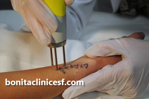 مزایای استفاده از لیزر کیوسوئیچ چیست؟