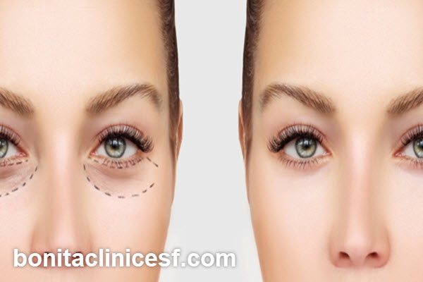 بهترین سن برای عمل بلفاروپلاستی | کلینیک بنیتا اصفهان