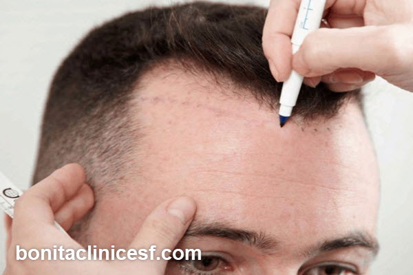 بهترین فصل کاشت مو چه زمانی است؟ | کلینیک بنیتا اصفهان