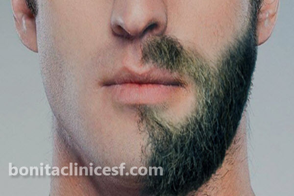 برای کاشت ریش از کجا مو برمیدارن؟