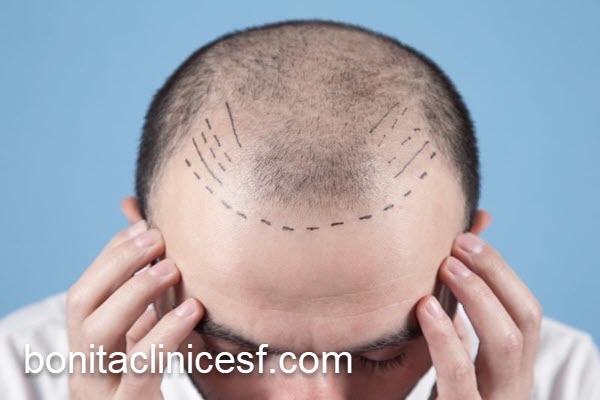 بررسی نتایج کاشت مو | کلینیک بنیتا اصفهان