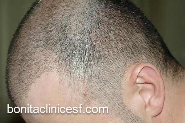 آیا نتایج کاشت مو دائمی است؟ | کلینیک بنیتا اصفهان