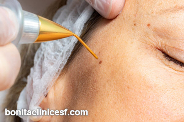 روش های برداشتن خال | کلینیک بنیتا اصفهان