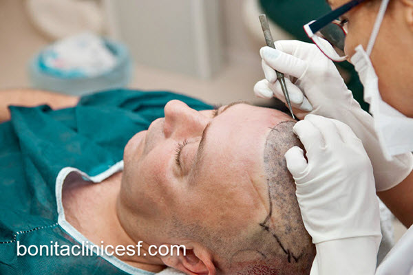 بهترین مرکز پیوند مو در اصفهان | کلینیک بنیتا اصفهان