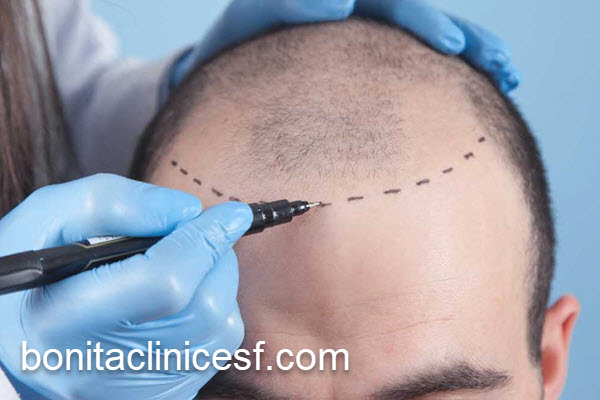 بهترین مرکز تخصصی پیوند مو در اصفهان | کلینیک بنیتا اصفهان