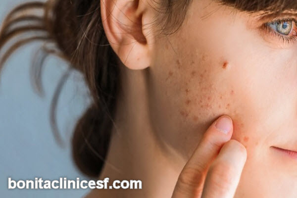 انتخاب بهترین دکتر برای برداشتن اسکارهای صورت و بدن در اصفهان | کلینیک بنیتا اصفهان