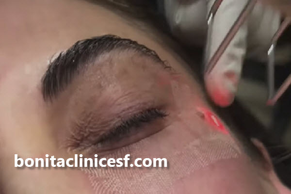 لیزر CO2 فرکشنال چیست؟