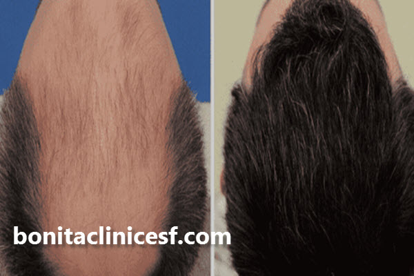 کاشت مو چیست؟ | اصفهان