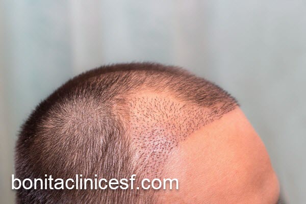 انجام کاشت مو با نتایج دائمی | کلینیک بنیتا اصفهان