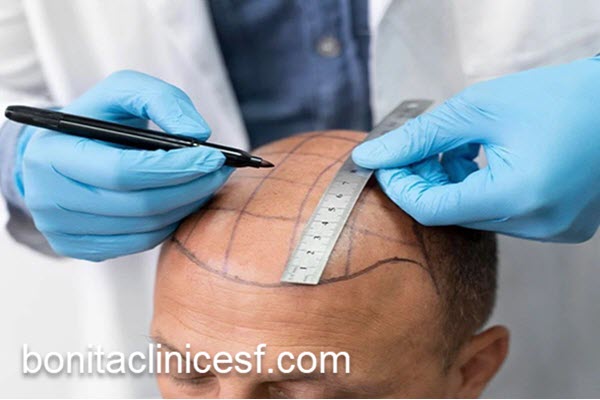 پیوند مو در بهترین مرکز زیبایی اصفهان | کلینیک بنیتا اصفهان