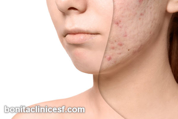 برداشتن اسکارهای صورت و بدن در اصفهان | کلینیک بنیتا اصفهان