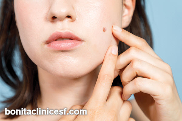 بهترین دکتر برداشتن خال در اصفهان | کلینیک بنیتا اصفهان