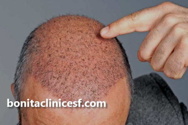 قیمت کاشت هر تار مو در سال 1403