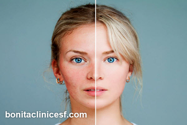 نکات مراقبتی پس از درمان اسکار | کلینیک بنیتا اصفهان