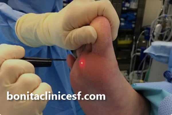 زگیل به چه دلایلی ایجاد می شود؟