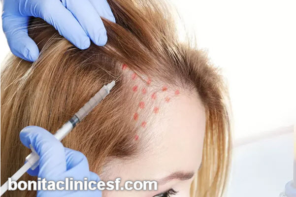 عوامل موثر بر تعداد جلسات پی آر پی PRP مو | کلینیک بنیتا اصفهان