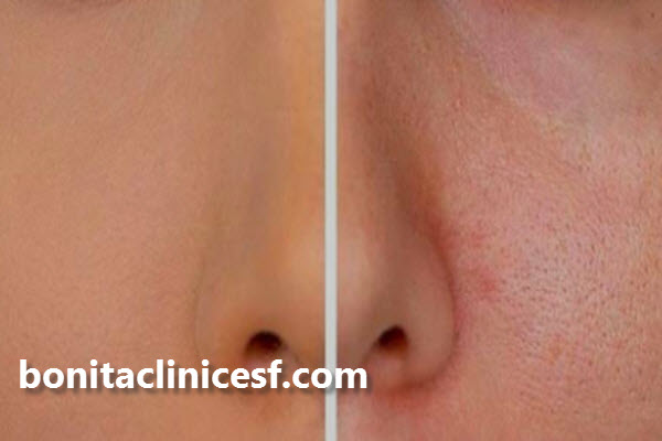 هایفوتراپی در چند جلسه انجام می شود؟