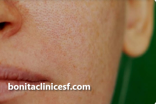 آیا هایفوتراپی برای منافذ باز پوست مفید است؟