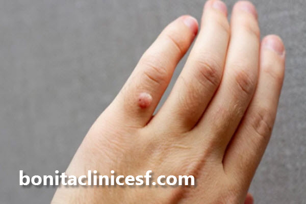 هزینه برداشتن زگیل با لیزر