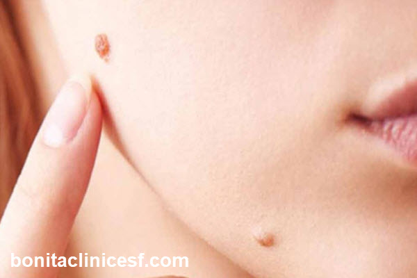 هزینه برداشتن خال در اصفهان چقدر است؟ | کلینیک بنیتا