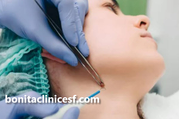 انواع خال کدامند؟ | اصفهان