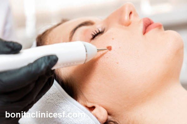 ویژگی های بهترین مرکز برداشتن خال در اصفهان | کلینیک بنیتا اصفهان