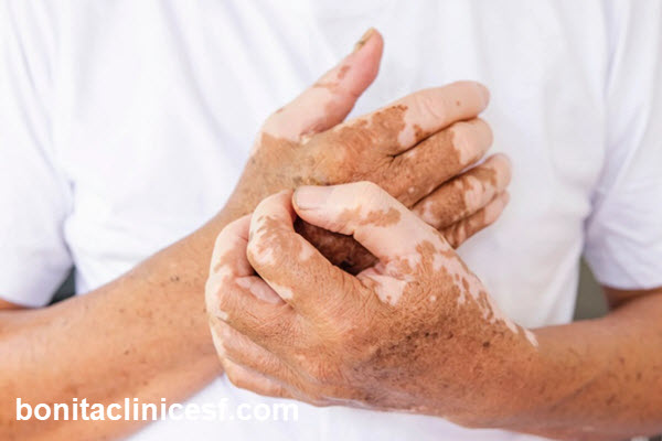 ویتیلیگو چیست؟ | کلینیک بنیتا اصفهان