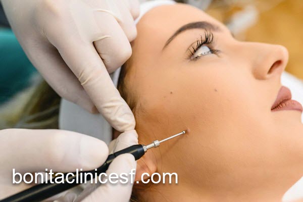 برداشتن خال صورت در فصل مناسب | کلینیک بنیتا اصفهان