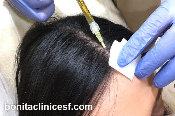 آیا پی آر پی مو دائمی است؟ | کلینیک بنیتا اصفهان