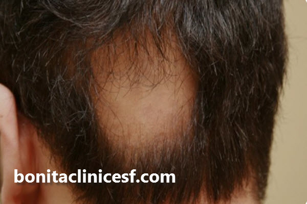 ریزش موی سکه ای چیست؟ | اصفهان