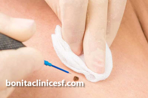 مراقبت های لازم بعد برداشتن خال