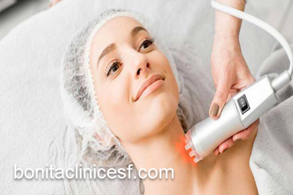 هزینه لیزر آر اف فرکشنال در 1404 | کلینیک بنیتا اصفهان