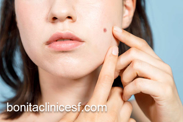 برداشتن خال در بهترین فصل | کلینیک بنیتا اصفهان