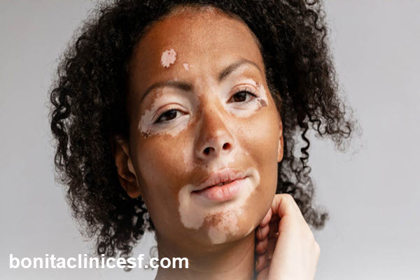 بهترین دکتر پوست برای درمان ویتیلیگو در اصفهان | کلینیک بنیتا