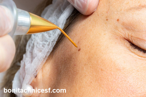 بهترین دکتر برداشتن خال و زگیل در اصفهان | کلینیک بنیتا