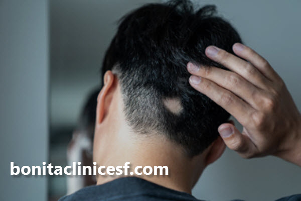 بهترین دکتر برای درمان ریزش مو سکه ای اصفهان