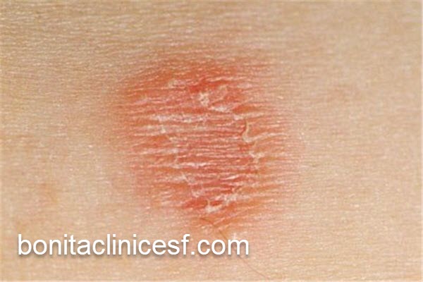 کلینیک معتبر بیماری قارچ پوستی در اصفهان | کلینیک بنیتا اصفهان