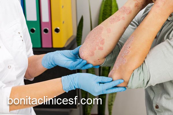 بهترین مرکز درمان بیماری قارچ پوستی | کلینیک بنیتا اصفهان