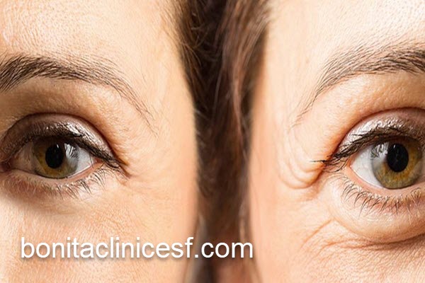 هزبنه عمل بلفاروپلاستی در اصفهان | کلینیک بنیتا اصفهان