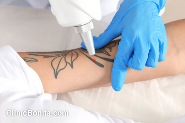 عملکرد دستگاه لیزر کیوسوئیچ | کلینیک بنیتا اصفهان