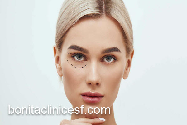 قیمت عمل بلفاروپلاستی در 1404 | کلینیک بنیتا اصفهان