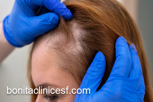 آشنایی با هزینه کاشت مو برای زنان | کلینیک بنیتا اصفهان