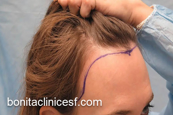 کاشت مو برای زنان با مناسب ترین قیمت | کلینیک بنیتا اصفهان