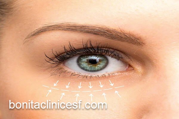 عمل افتادگی پلک با قیمت مناسب | کلینیک بنیتا اصفهان